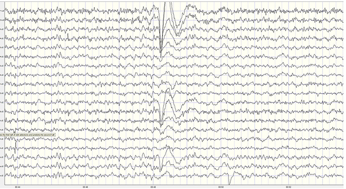 Desynchronized EEG tracing